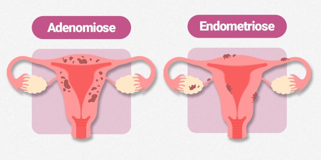 Qual a diferença entre adenomiose e endometriose?