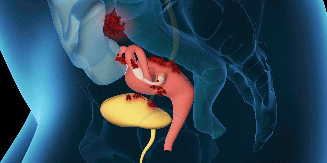 O Que é Endometriose Na Bexiga O Que é Endometriose Na Bexiga